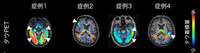 PET images of the brains of patients who developed mood disorders after turning 40. White arrows point to abnormal tau protein accumulation, while orange arrows indicate accumulation also seen in healthy individuals. (Courtesy of the National Institutes for Quantum Science and Technology)